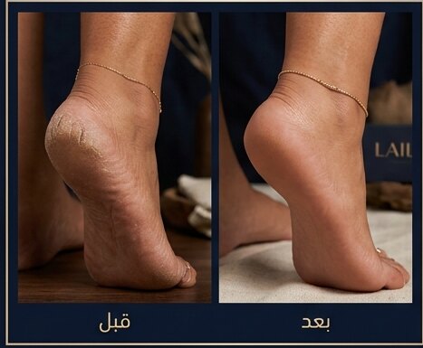 مقارنة قبل وبعد: جلد ناشف ومتشقق، ومن بعد بشرة ملساء